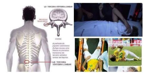 Neymar Cedera Tulang Belakang di Brazil  2
