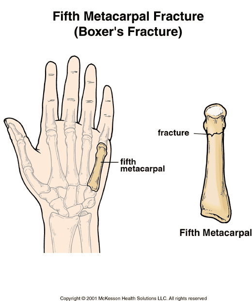 marquez patah tulang telapak tangan kiri jelang motogp jepang 2015 pertamax7.com